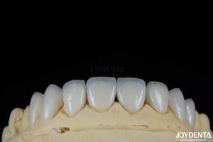 Quality Glossy Surface Texture Feldspathic Veneer Natural Looking Porcelain Veneer wholesale