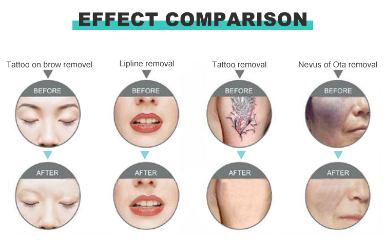 1-10HZ Frequency 10.4 Inch Touch Color Screen Laser Carbon Peel and Tattoo Removal Machine