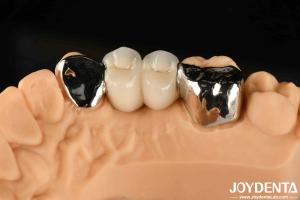 Quality Metallic Dental Maryland Bonded Bridge Good Remediation For Oral Clinical Repair wholesale