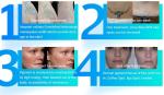 New technology Q Switched Nd Yag Laser For Tattoo Removal Skin Whitening