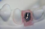 Removable Pure Titanium Dental Implant Bar Custom Abutment
