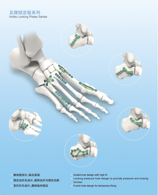 3 4 Holes Short Long Calcaneus Fracture Plate Type V L/R