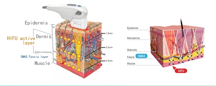 Effective 3D hifu face lifting machine/11 lines 3d hifu wrinkle removal machine for sell