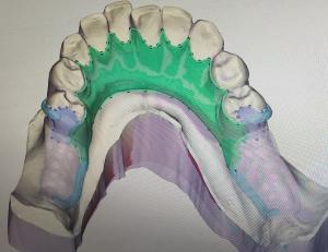 China Removable 3D Printed Partial Denture Metal Framework on sale