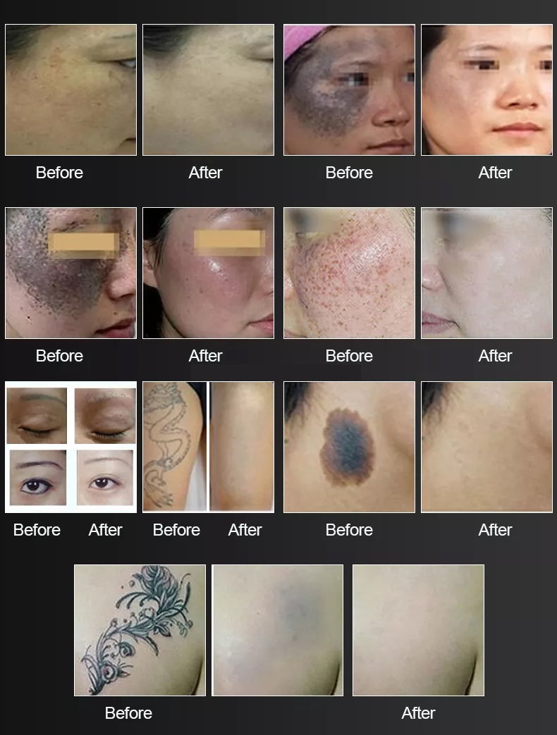 Portable Q Switched Nd Yag Laser Tattoo Removal Machine with 1064nm 532nm 1320nm Nd-yag Pigmentation Removal
