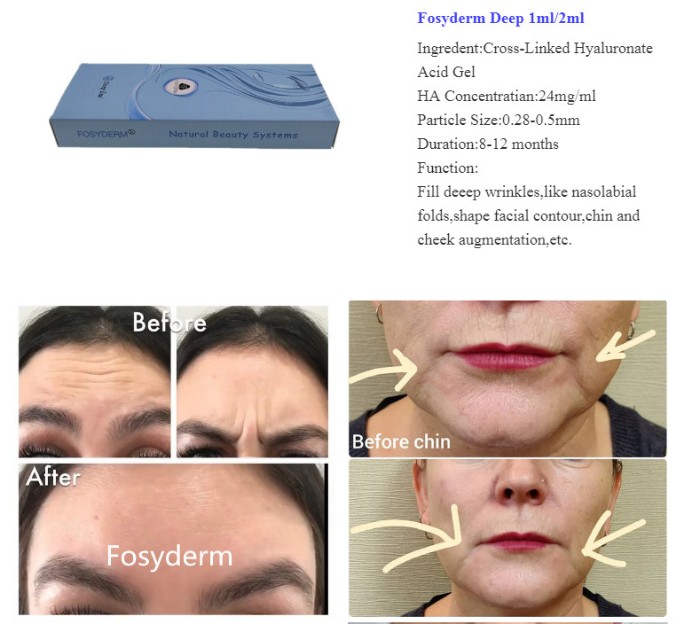 Fosyderm Hyaluronic Acid Injection Face 1ml 2ml 10ml 20ml 50ml Cross Linked