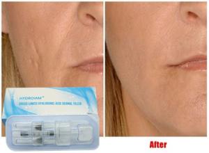 Quality Hyaluronic Acid Injectable Filler 10ml For Lip Injection Cheeks Chin Augmentation wholesale