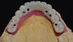 Elevating Standards Our Dental Implant Crown Quality Assurance