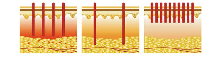 Safe 1550 Er Yag Laser Lifotronic Fractional Erbium Glass Laser for Skin Resurfacing