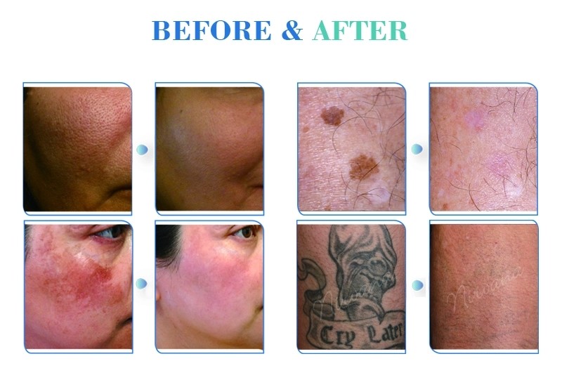 Best Effective Advanced Carbon Peeling Treatment 532nm 755nm 1064nm Picosecond 600ps Laser Tattoo Freckle Removal Machin