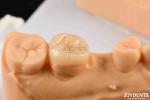 High Strength Emax Inlay Onlay A2 Color Long Lasting For Damaged Teeth