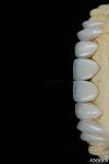 Glossy Surface Texture Feldspathic Veneer Natural Looking Porcelain Veneer