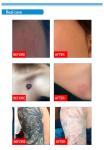tattoo removal machine