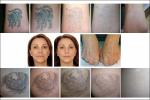 500-800ps Pico Laser Tattoo Removal Machine Nd Yag Use For Doctor Toys