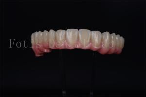 Quality Full Arch Implant Bridge All On 4 All On 6 For Complete Dental Restoration wholesale