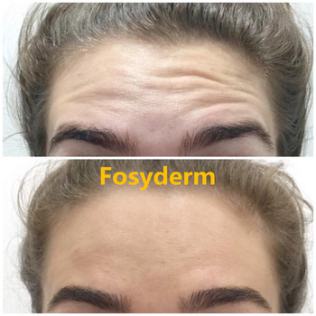 Anti Wrinkle Dermal Filler Hyaluronic Acid Facial Filler Injection 2ml Deep