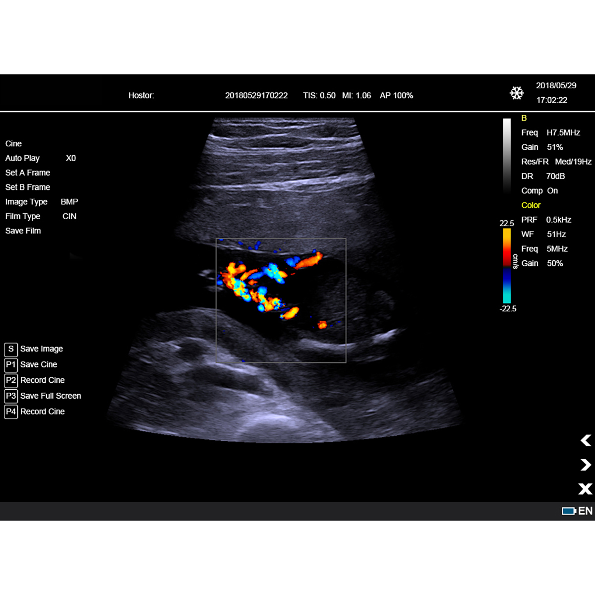 Color Doppler Portable Ultrasound Machine Medical USG PW CW DICOM Cardiac Probe Cardiology for Hospital Clinic