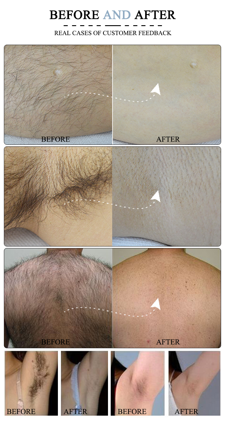2000w Professional Laser Hair Removal Machine 808 Diode LCD Touch Screen ODM