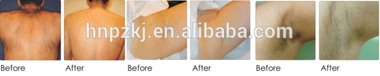 Vertical 3 In 1 Pain Free Laser Hair Removal Machines / Laser Skin Care Machine