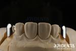 Precision Removable Prosthesis Dental Implant Attachments Easy Clean Comfortable