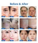 Anti Acne Spot Freckle Removal Skin Lifting Plasma Pen Double Chin Removal