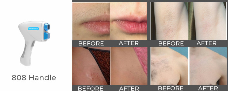 4h Diode Laser Hair Removal Equipment Design Oem Odm
