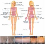 Platinum DPL Laser Hair Removal Machine 808nm Diode