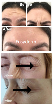 HA Cross Linked Hyaluronic Acid Wrinkle Fillers Injections For Deep Face Wrinkles