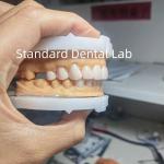 Perfect Esthetics Provisional Wax Up for Dental Professionals using dental wax