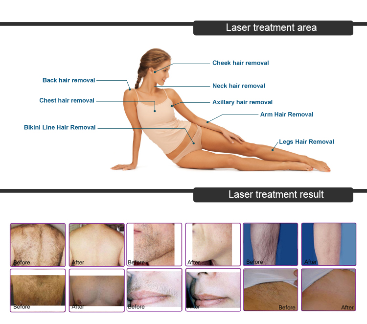 One 808nm Diode Laser Handle Discount Prices Body Hair Removal Machine for Women