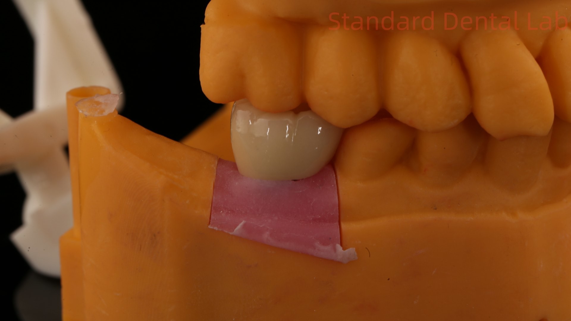 Dental Implant Screw Retained Crown PFZ Porcelain Layered Zirconia With 3D Print Model