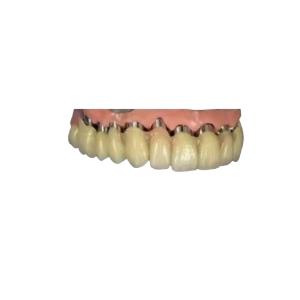 Quality CAD CAM PFM Implant Crown Bridge Telescopic Crown Dental 3D Printed Models wholesale