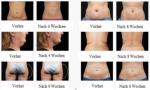 High Quality Cryolipolysis Cool Technology 4 Cryo Head Liposuction Slimming Fat