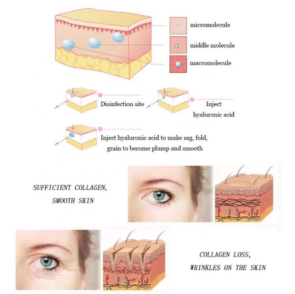 Fosyderm Brand Lip Hyaluronic Acid 2ml Dermal Filler Special For Lip