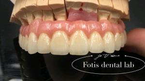 Quality Reliable Restoration PFM Dental Crowns Porcelain Fused To Metal Crown Customized wholesale