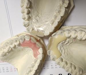 China Resin Metal Free Invisible Denture For Allergic Patient on sale