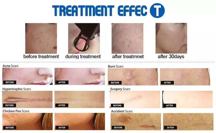 Scar Removal Fractional CO2 Laser Beauty Equipment With 10.4 Inch LCD Touch Screen