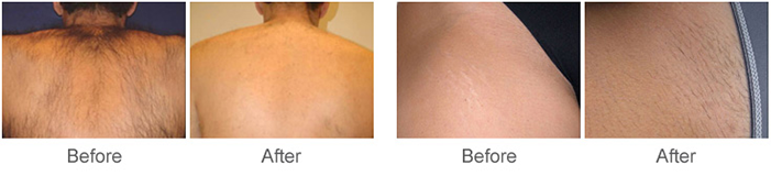 Facial Hair Removal Laser Machine / Laser Depilation Equipment With 3 Wavelength