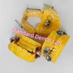 Dental Functional Orthodontic Herbst Appliances From China Dental Lab