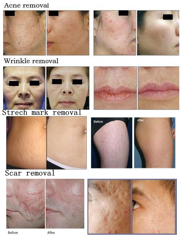 CE approved high efficiency Fractional Co2 Laser Machine for Scar&wrinkle removal