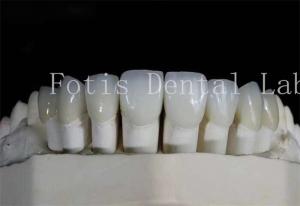 Quality Polished Dental Laminate Veneers High Translucency For Natural Looking Smiles wholesale
