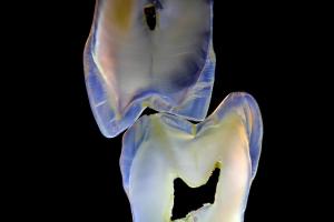 Quality Fixed Prosthetics Permanent Solution EMAX Dental Crown wholesale