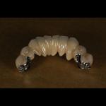 Aesthetic Precision Dental Implant Ball Attachment Partial Dentures