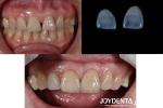 0.5mm Thickness Dental Veneers Perfect Permeability Porcelain Veneers For Gap