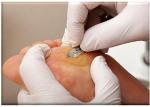 15 Watts Podiatry Laser 980nm Podiatrist Laser Treatment Toenail Fungus