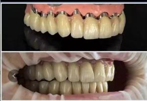 Quality Dental implants Telescope PFM porcelain bridge wholesale