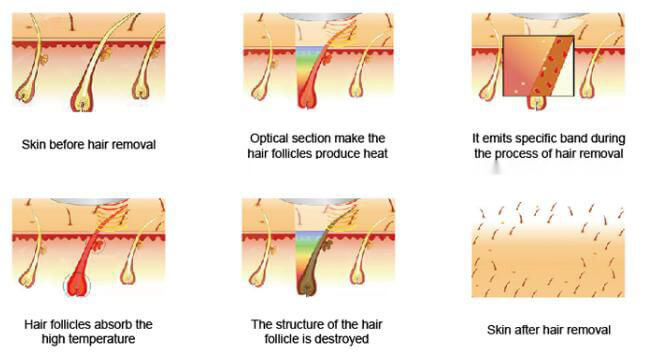 Lcd Medical Ce Approved Shr Hair Removal Machine Painless