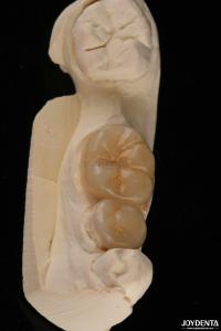 Quality Emax Dental Inlays And Onlays Fracture Resistant 1.5mm Low Translucency wholesale