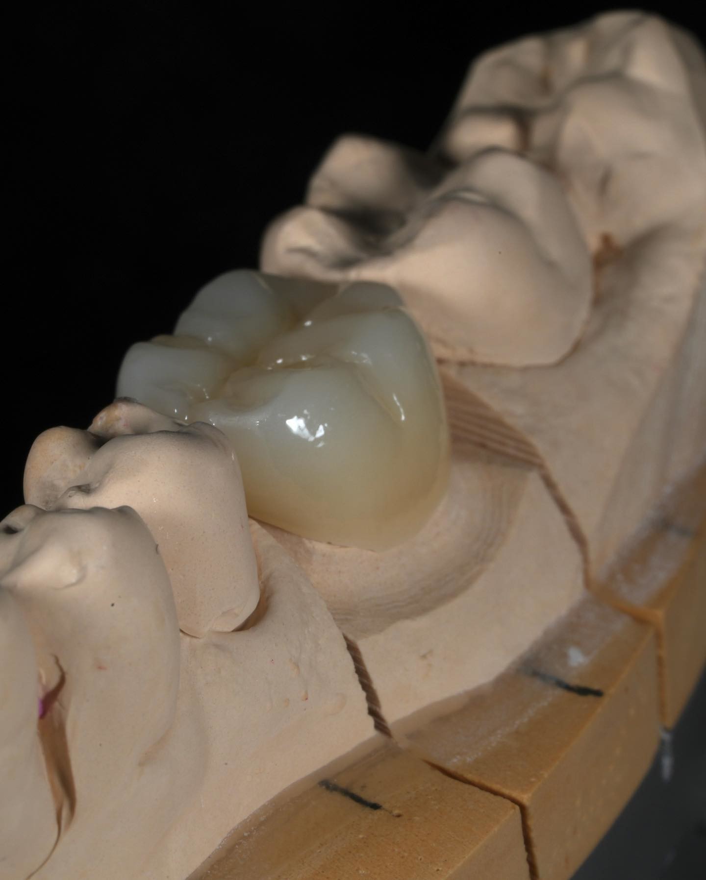 Full Contour Zirconia Crown Quick Turnaround for Precise and Aesthetic Fit in 1 Week