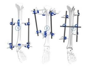Quality Flexible Orthopedic Trauma Implants Tibial Plateau Frame External Fixation wholesale